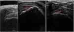 Real-time Self-supervised Ultrasound Image Enhancement Using Test-Time Adaptation for Sophisticated Rotator Cuff Tear Diagnosis
