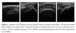 Imbalanced Loss-Integrated Deep-Learning-based Ultrasound Image Analysis for Diagnosis of Rotator-Cuff Tear