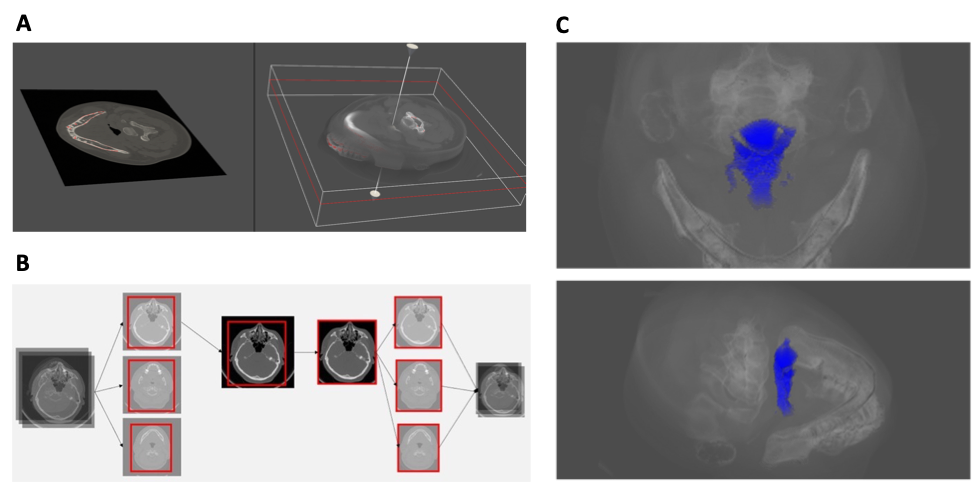 Predicting Obstructive Sleep Apnea Based On Computed Tomography Scan