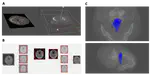 Predicting Obstructive Sleep Apnea Based on Computed Tomography Scan Using Deep Learning Models