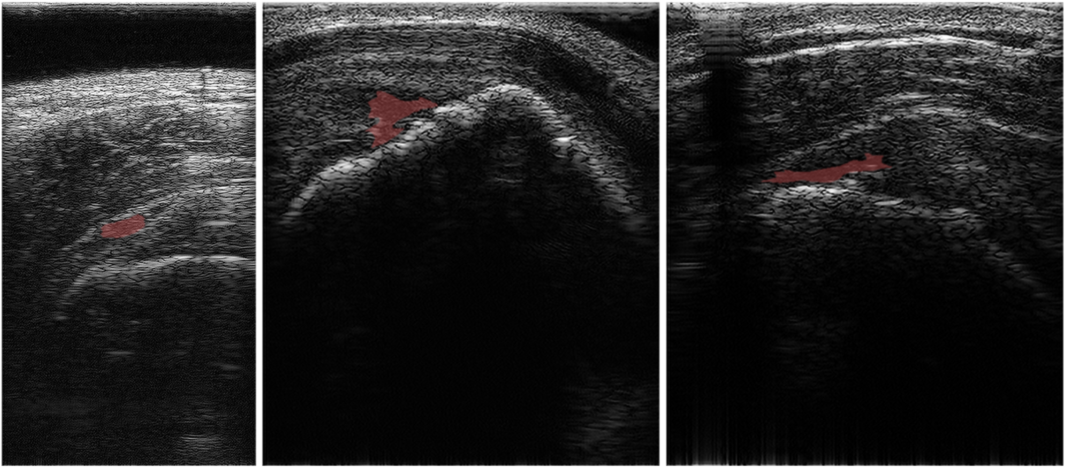 Real-time Self-supervised Ultrasound Image Enhancement Using Test-Time Adaptation for Sophisticated Rotator Cuff Tear Diagnosis